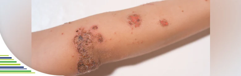 Impetigo na dětském paži s typickými žlutohnědými kůrkami.
